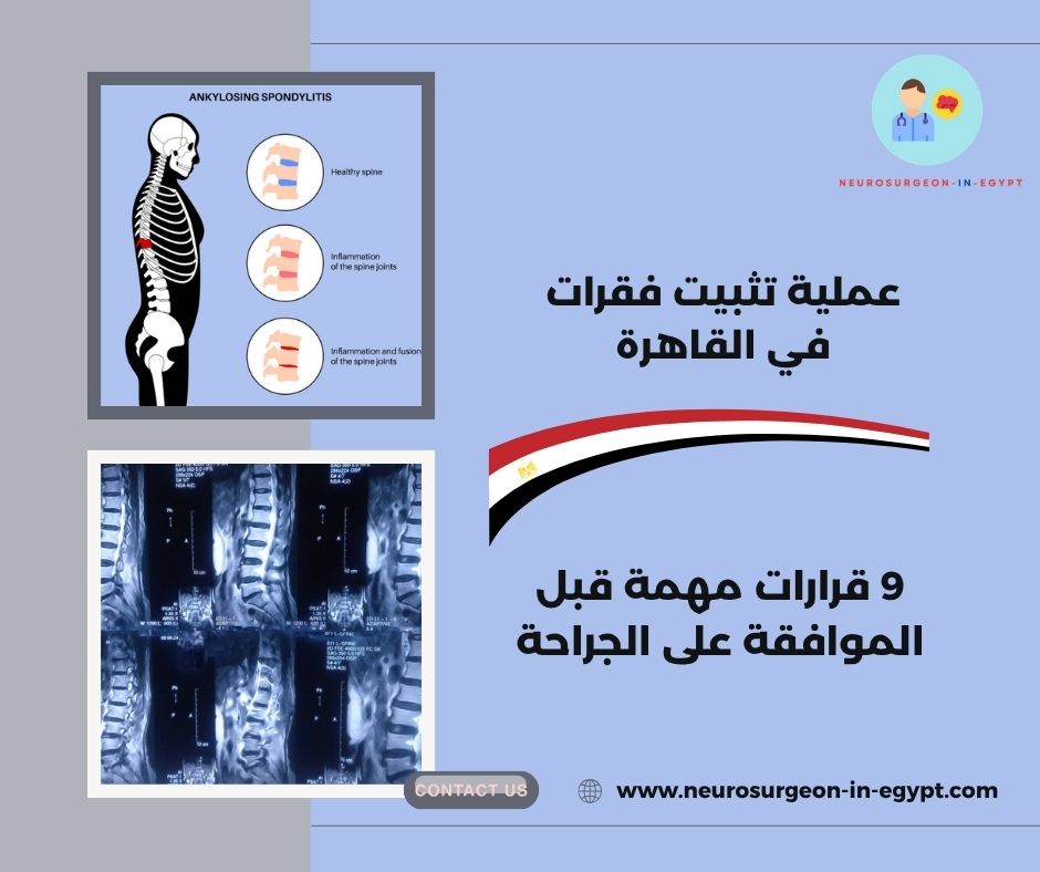 عملية تثبيت فقرات في القاهرة